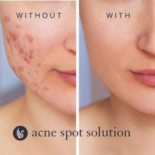 Acne Spot Solution
