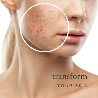 Acne Bundle
